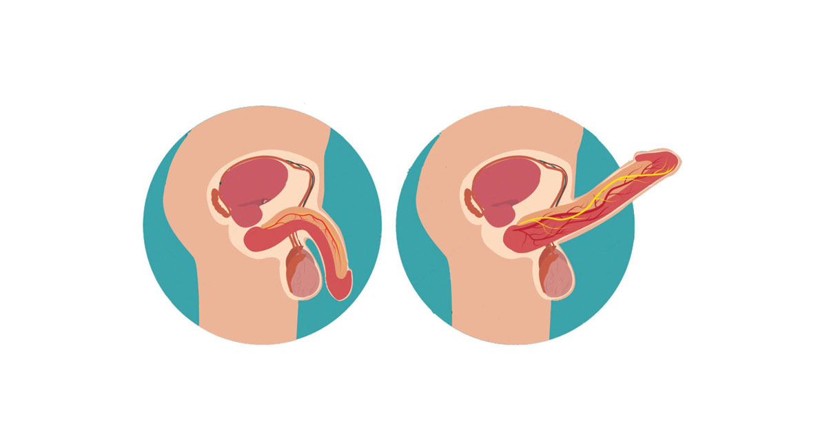 Iniezioni PRP disfunzione erettile